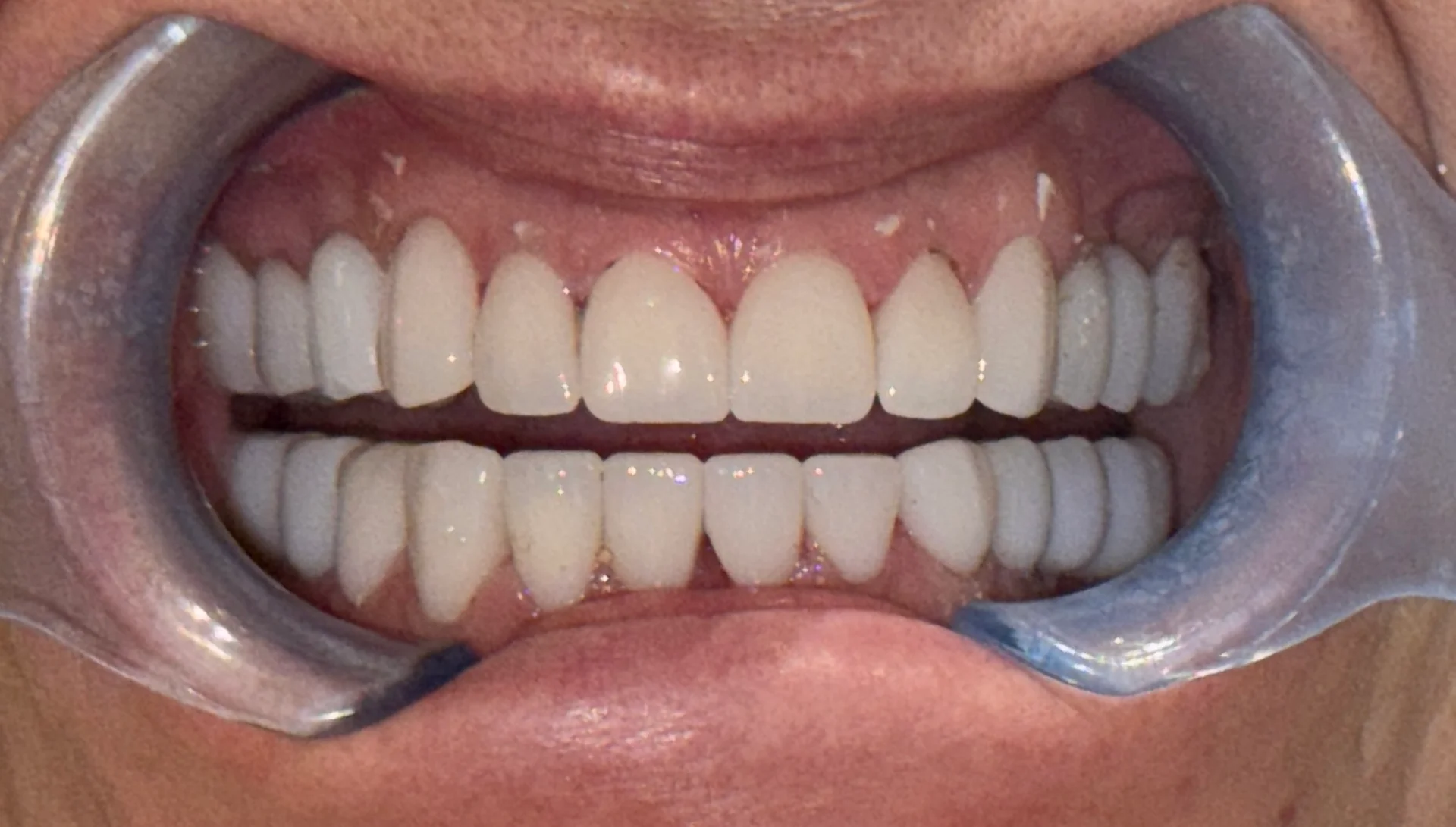 Zâmbet transformat cu fațete dentare realizate la Denteca Smile Clinic