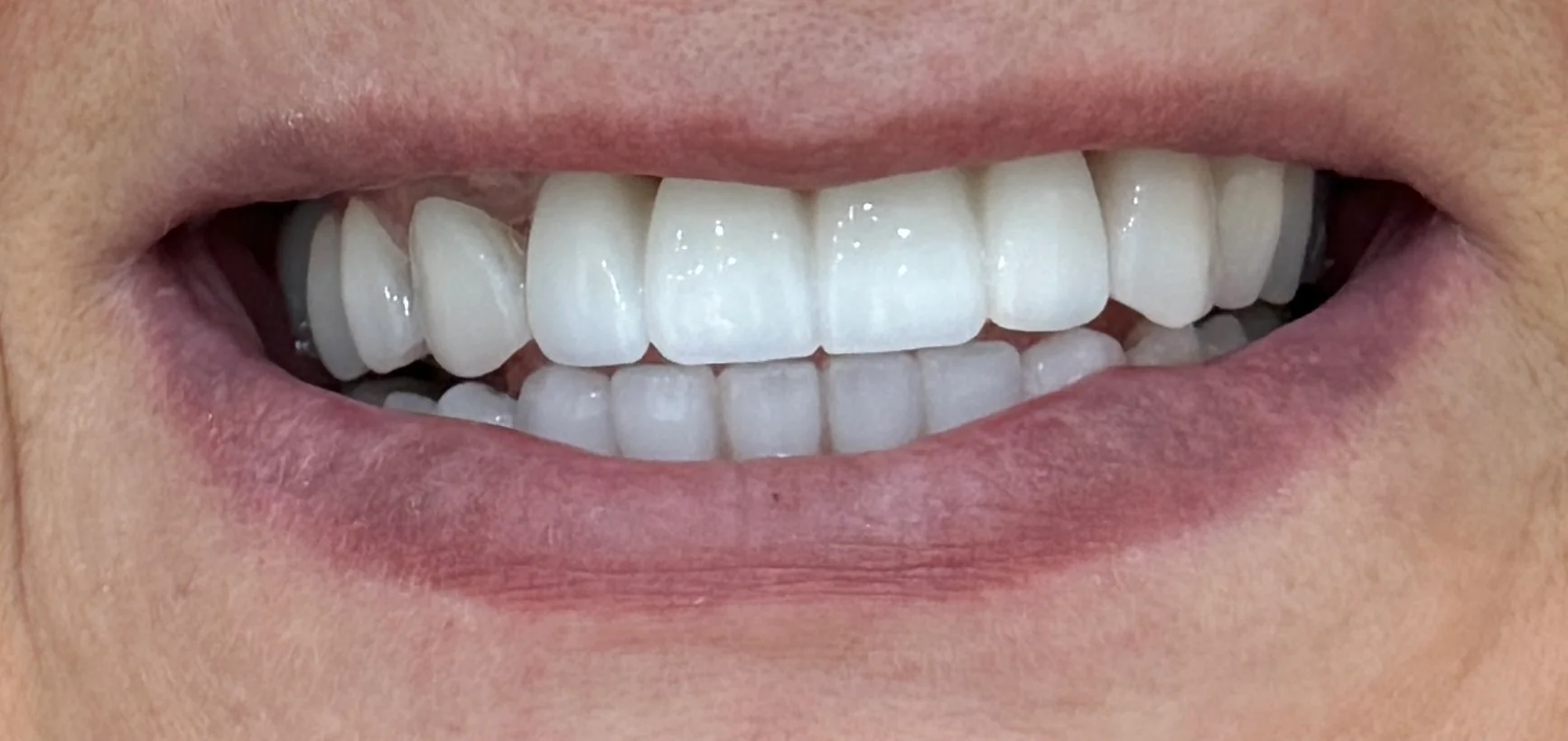 Rezultat tratament estetic dentar la Denteca Smile Clinic București