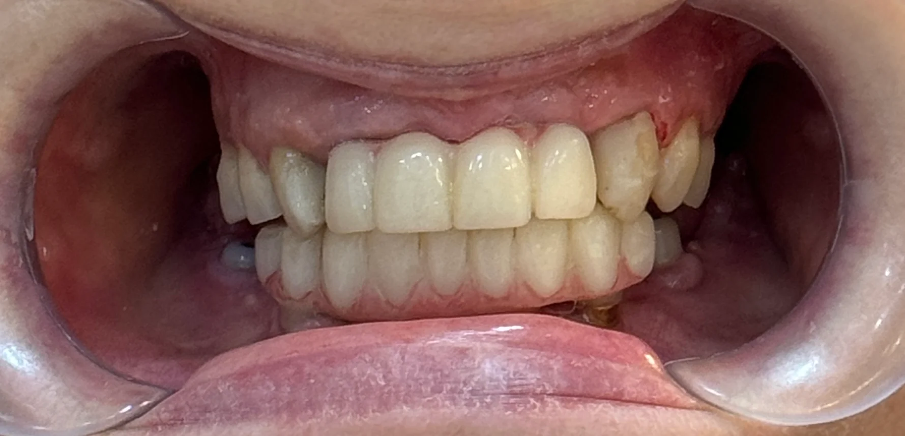 Aspect inițial dantură înainte de tratament la Denteca Smile Clinic