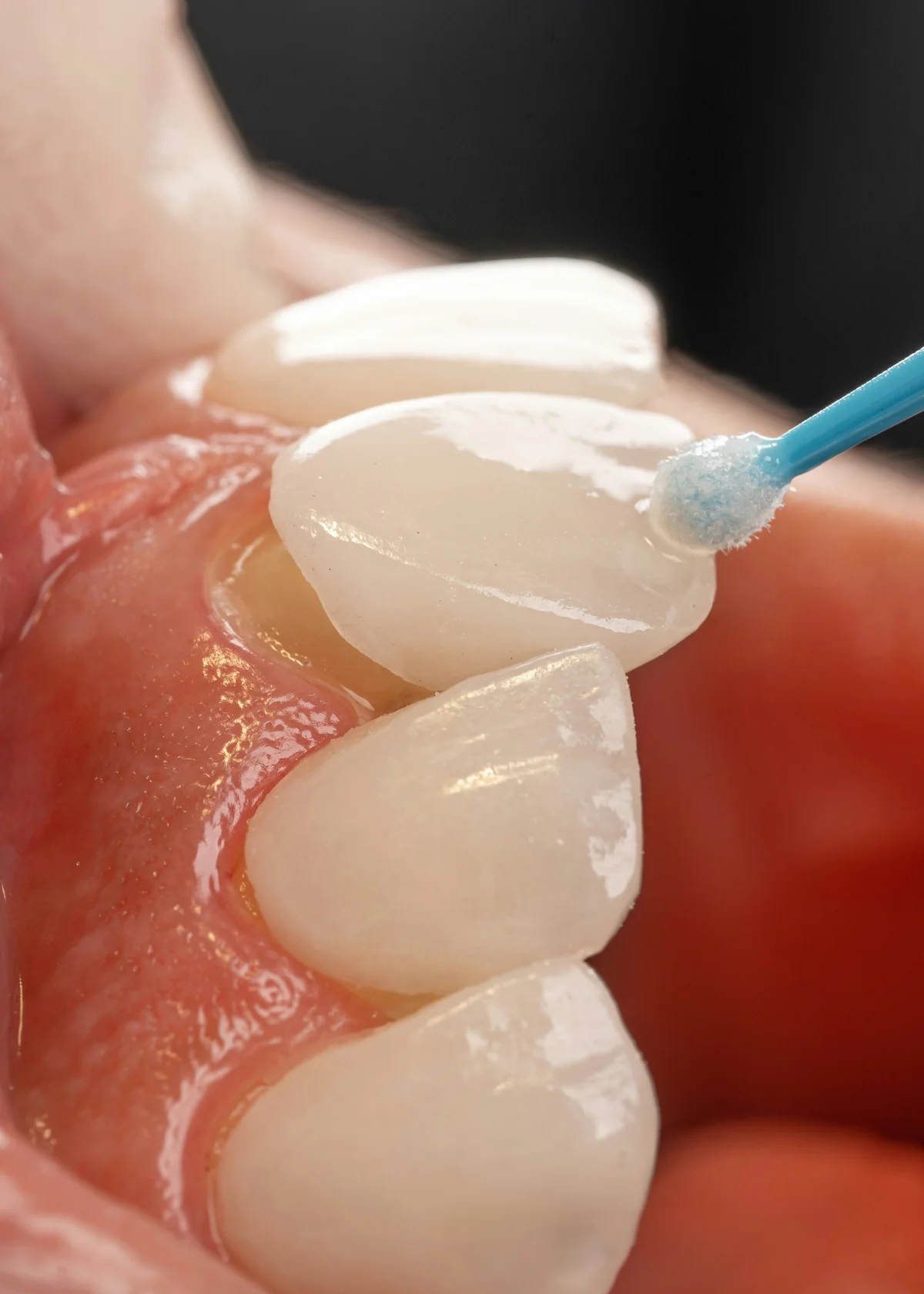 Cimentare fațete dentare ceramice la clinica Denteca Smile București