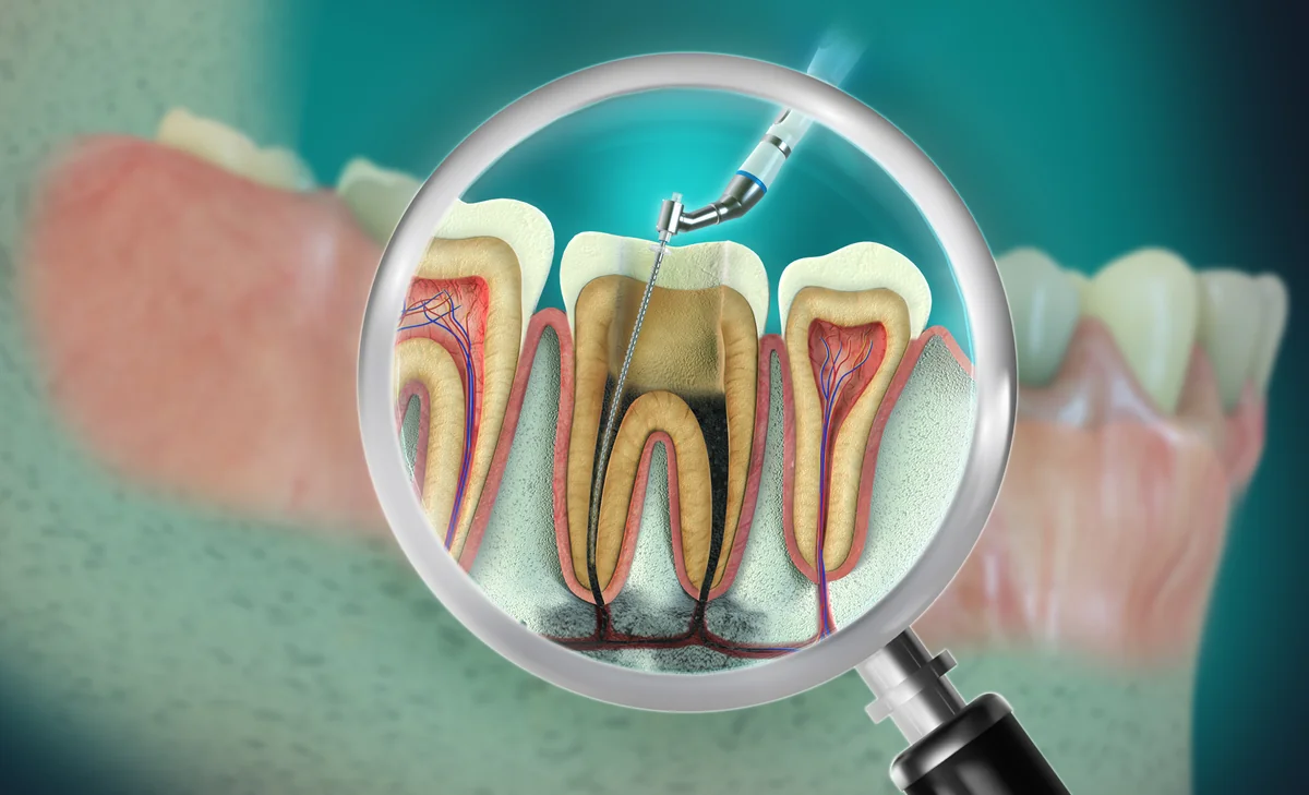 Tratament canal radicular la microscop Denteca Smile Clinic București